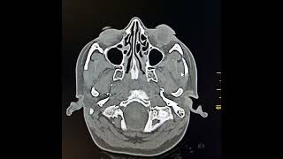 Otitis media and acute mastoiditis [upl. by Alam614]