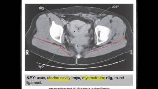 The Pelvis CT Anatomymp4 [upl. by Eerahs]