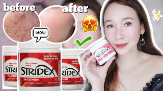 BEST amp EFFECTIVE SALICYCLIC ACID FOR ACNE PRONE SKIN STRIDEX TONER PADS REVIEW PHILIPPINES [upl. by Dnarud]