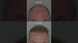 Restoring the frontal forelock  Anthony Bared MD FACS  Miami FL [upl. by Yetak74]