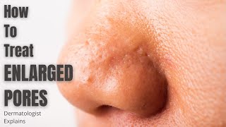 Enlarged Pores  How to effectively treat [upl. by Kumler]