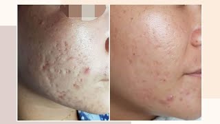 REAL and LEGIT ACNE SCARS TREATMENT SOLUSYON SA ACNE SCARS  ACNE SCAR REMOVAL AcneScarJourney [upl. by Macegan241]