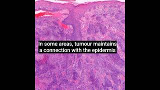 Histopathology of Porocarcinoma dermatopathology dermpath shorts [upl. by Litton]