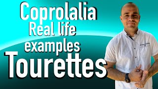 Coprolalia Part 2 Tourette’s real examples from my experience tics tourettes tourettesyndrome [upl. by Ymmaj]