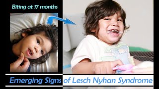 Early Emerging Signs of Lesch Nyhan Syndrome in DaveyBiting Started at 17 months [upl. by Sacks]