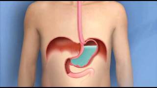 Heartburn Acid Reflux GERDMayo Clinic [upl. by Rebe622]