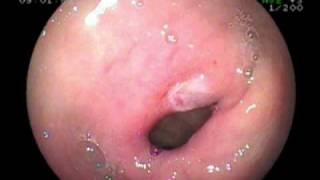 pyloric Channel Ulcer [upl. by Allina]