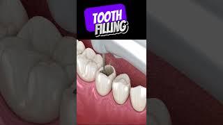 How is tooth filling done [upl. by Reivaz24]