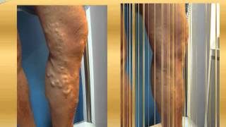 Varicose vein before and after Part 3  varicose vein treatment varicose surgery [upl. by Ahsrop]