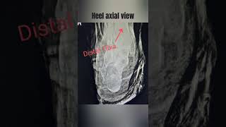 calcaneus axial viewLateralobliqueheel axial view created by techno gauravgauravtechnologist [upl. by Elwood110]