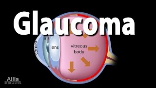 Development of Glaucoma Animation Open Angle vs Angle Closure Glaucoma [upl. by Iem477]