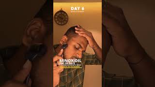 Derma rolling and Minoxidil for Hair Growth  Day 7 hairloss dermaroller hairgrowth minoxidil [upl. by Jorrie]