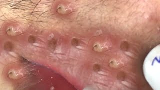 Clean Giant Blackheads on on the Lips [upl. by Helbonnas]