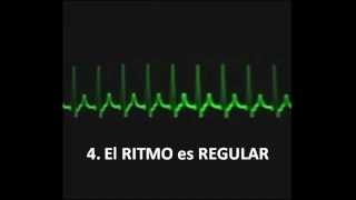 TAQUICARDIA SUPRAVENTRICULAR PAROXÍSTICA ANÁLISIS [upl. by Nnayt]