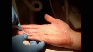 Dr Patrick Treacy demonstrates Botox for Sweaty Palms [upl. by Freddi462]