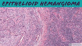 Epithelioid Hemangioma aka ALHE 5Minute Pathology Pearls [upl. by Trabue53]