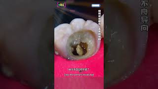 Restoring a broken tooth Root canal treatment [upl. by Amitak635]