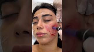 MEDİKUS KLİNİK  KOSMETOLOJİ  DERMATOLOJİ PROSEDURLAR [upl. by Marb345]