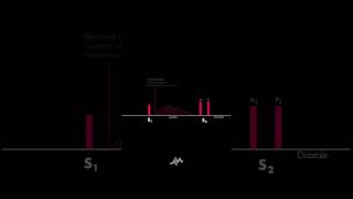 Pulmonic Stenosis [upl. by Meerek]