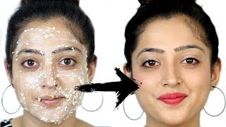 Face Pack for Acne Prone Skin  मुहांसों के लिए फेस पैक [upl. by Ttessil684]