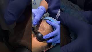 Lichen Planus with Qswitched NdYAG Laser drthajlifestyle [upl. by Riggs389]