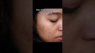 Do your ACNE SCARS LOOK LIKE THIS skincare skincareroutine [upl. by Ibob]