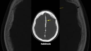 Calcificaciones Intracraneales por tomografía Radiología Neuroimagen Tomografía Medicina [upl. by Yruy]