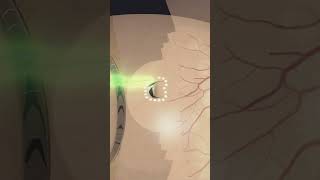 Laser photocoagulation around retinal tear laser eyes eyecare eyesurgery [upl. by Beth]