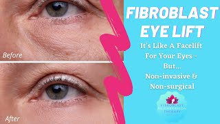 FIBROBLAST EYE LIFT  It’s Like A Facelift For Your Eyes But Noninvasive amp Nonsurgical [upl. by Townshend430]