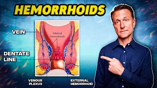 The 1 Best Remedy for Hemorrhoids  Dr Berg [upl. by Rugen]