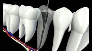 Root Canal Procedure 3D Animation  Endodontics Los Angeles [upl. by Neelahs]