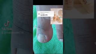 Extremely tight toenail digging With sound when out nail​​​ asmr fyp ear shorts viral wax [upl. by Pierpont65]