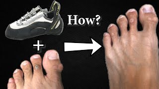 How to Treat Foot Corns Caused by Tight Climbing Shoes [upl. by Ihteerp667]