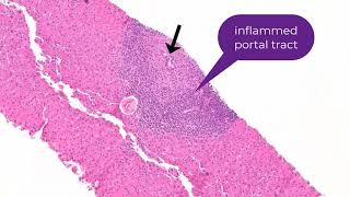 Histology of Primary Biliary Cholangitis [upl. by Delos]