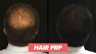 Revolutionary Hair PRP Therapy Boost Natural Hair Regrowth and Thickness [upl. by Cammi760]