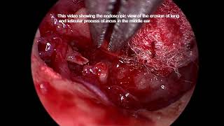 Endoscopic view of the erosion of incus [upl. by Pestana]