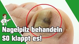 Nagelpilz behandeln  SO klappt es 👣💅 [upl. by Mays]