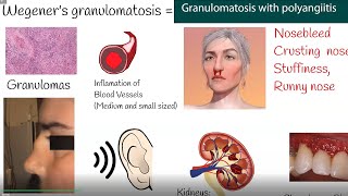 Wegeners granulomatosis  Granulomatosis with polyangiitis  Symptoms and causes [upl. by Ahsenyt]