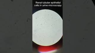 Renal tubular epithelial cells in urine microscopyshorts [upl. by Tymes]