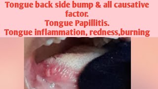 Tongue back side bump amp all causative factorTongue PapillitisTongue inflammation rednessburning [upl. by Madelina187]