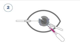 Supporting device for the insertion of an intraocular lens [upl. by Lenette]