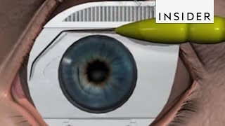 How LASIK Eye Surgery Is Performed [upl. by Squires453]