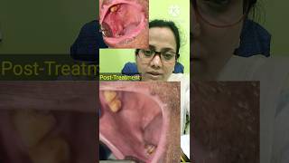 Lichen PlanusTreatment of Lichen PlanusAutoimmune DiseaseOral ulcer healed after TreatmentShorts [upl. by Saravat]