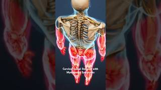 Cervical Spinal Stenosis with Myelopathy Symptoms [upl. by Niel808]