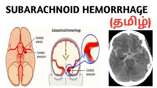 Subarachnoid Hemorrhage  Causes  Symptoms  Diagnosis  Treatment  தமிழ் [upl. by Ennagrom]