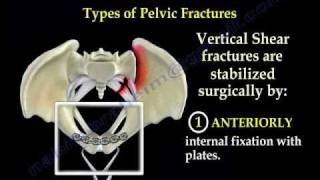 Pelvic Fracture Overview  Everything You Need To Know  Dr Nabil Ebraheim [upl. by Arammat]