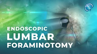 What is Endoscopic Lumbar Foraminotomy [upl. by Lunnete]