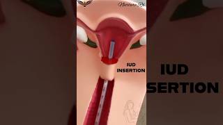 IUD insertion precautions pregancy nclex nurses nursing iud uterus child birth control [upl. by Modestine]