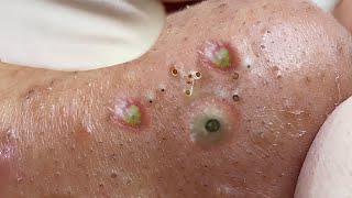 Big Cystic Acne Blackheads Extraction Blackheads amp Milia Whiteheads Removal Pimple Popping  6645 [upl. by Mingche241]