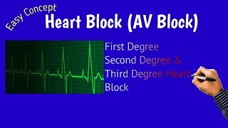 Heart Block  AV block Atrioventricular Block [upl. by Bunch]